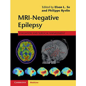 Elson L So: MRI-Negative Epilepsy